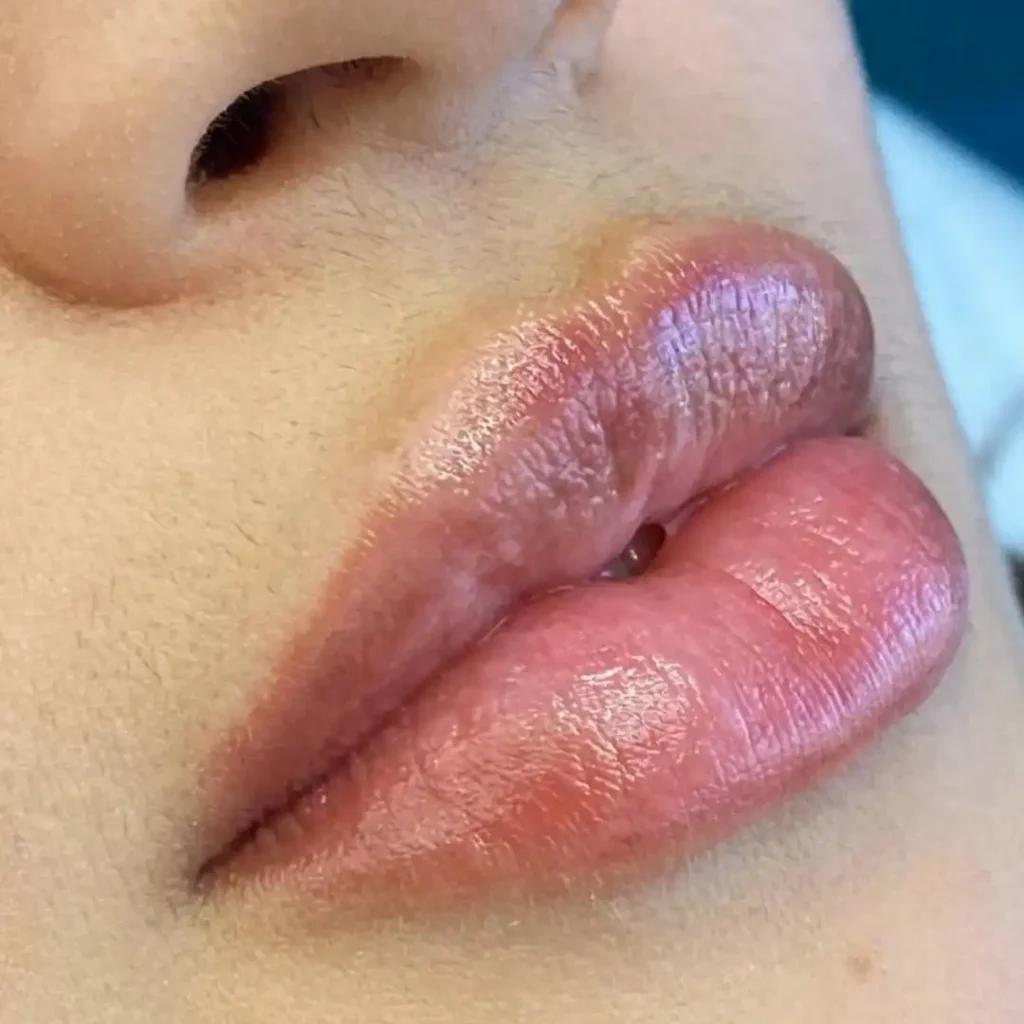 Profissional realizando procedimento de preenchimento labial em clínica estética em Curitiba, Paraná.