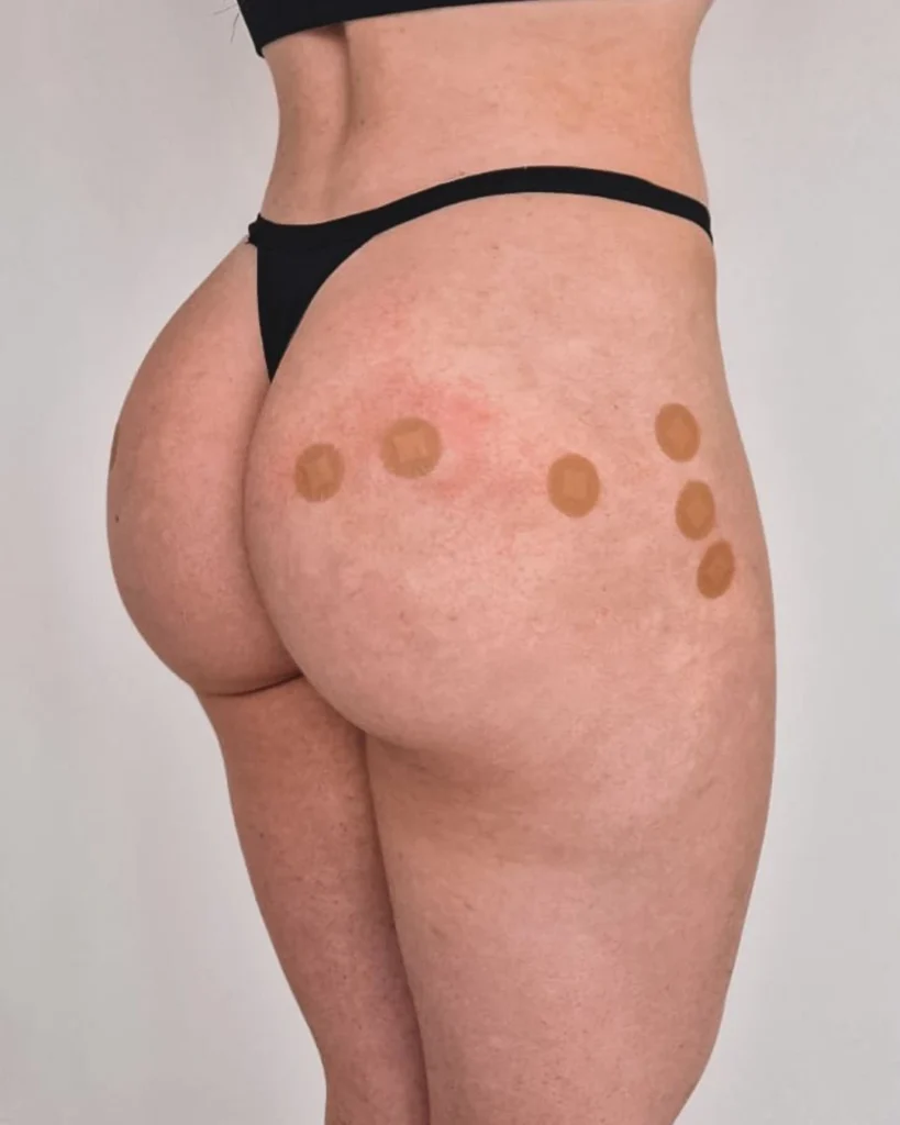 Profissional realizando procedimento de harmonização de glúteos em clínica estética em Curitiba, Paraná.