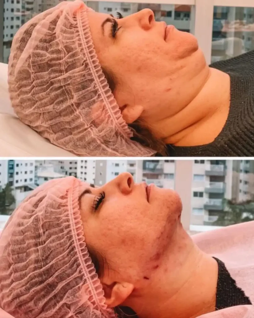 Profissional realizando procedimento de lipo de papada em clínica estética em Curitiba, Paraná.