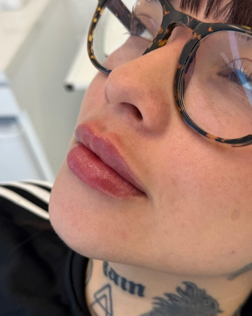 Preenchimento labial em clínica de estética em São José SC